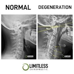 what-is-upper-cervical-